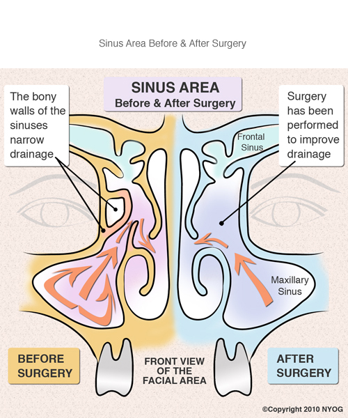 Sinus Surgery NYC